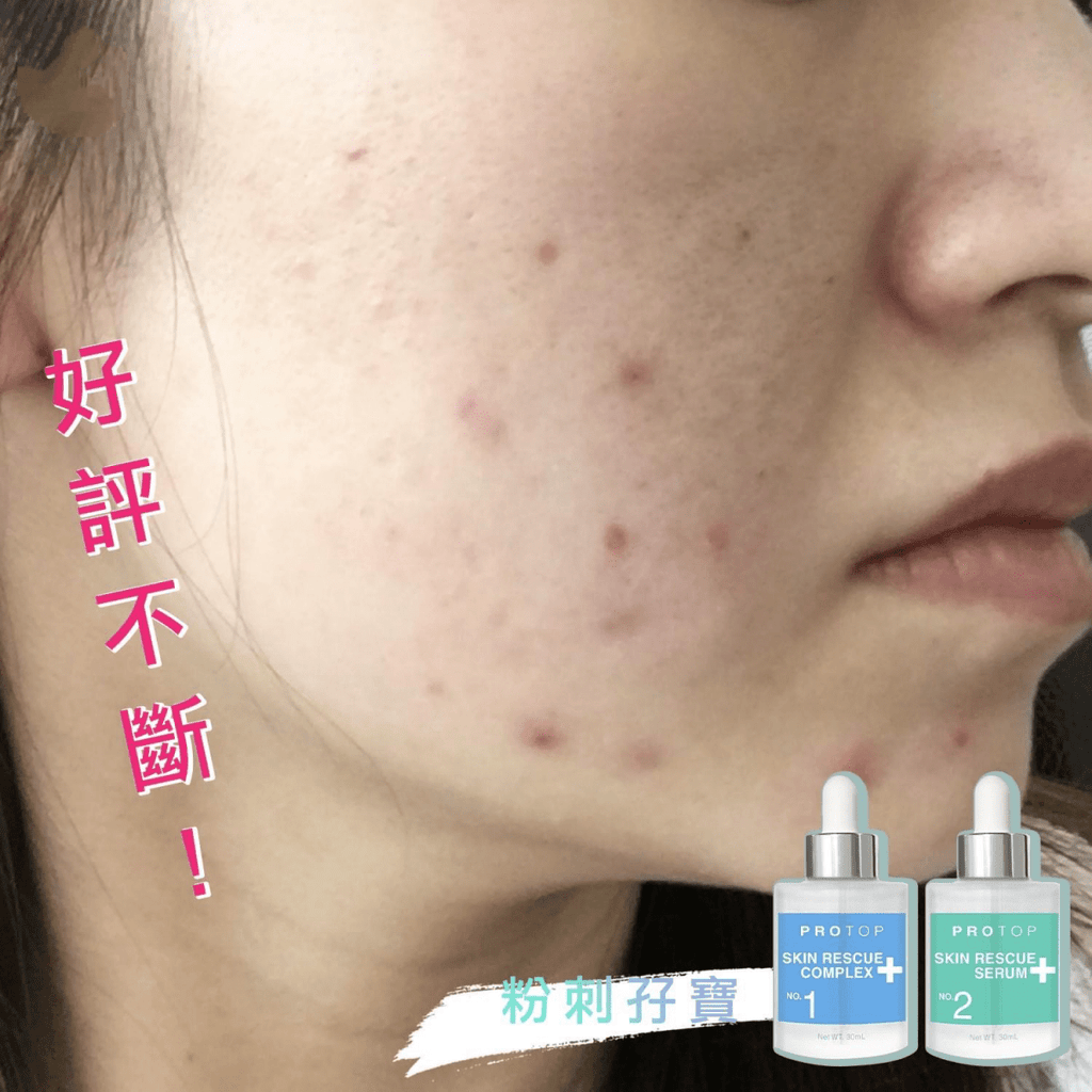 抗炎淨痘 - Beauty decoder 醫美護膚品專門店